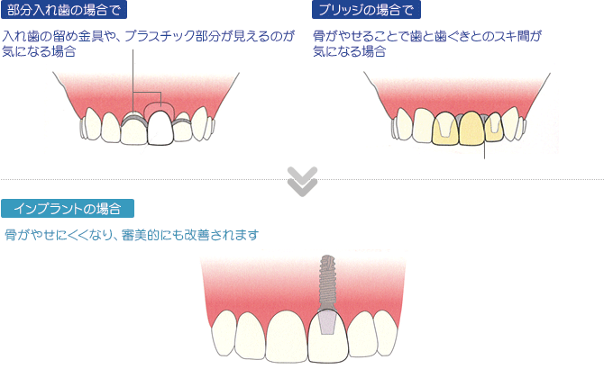 部分入れ歯の場合で入れ歯の留め金具や、プラスチック部分が見えるのが気になる場合。ブリッジの場合で骨がやせることで歯と歯ぐきとのスキ間が気になる場合⇒インプラントの場合骨がやせにくくなり、審美的にも改善されます