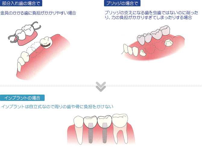部分入れ歯の場合で金具のかかる歯に負担がかかりやすい場合。ブリッジの場合でブリッジの支えになる歯を虫歯ではないのに削ったり、力の負担がかかりすぎてしまったりする場合⇒インプラントの場合インプラントは自立式なので周りの歯や骨に負担をかけない