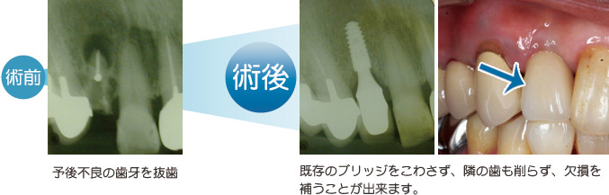 術前、予後不良の歯牙を抜歯。術後、既存のブリッジをこわさず、隣の歯も削らず、欠損を補うことが出来ます。