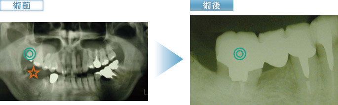 歯牙移植の症例②の術前、術後写真